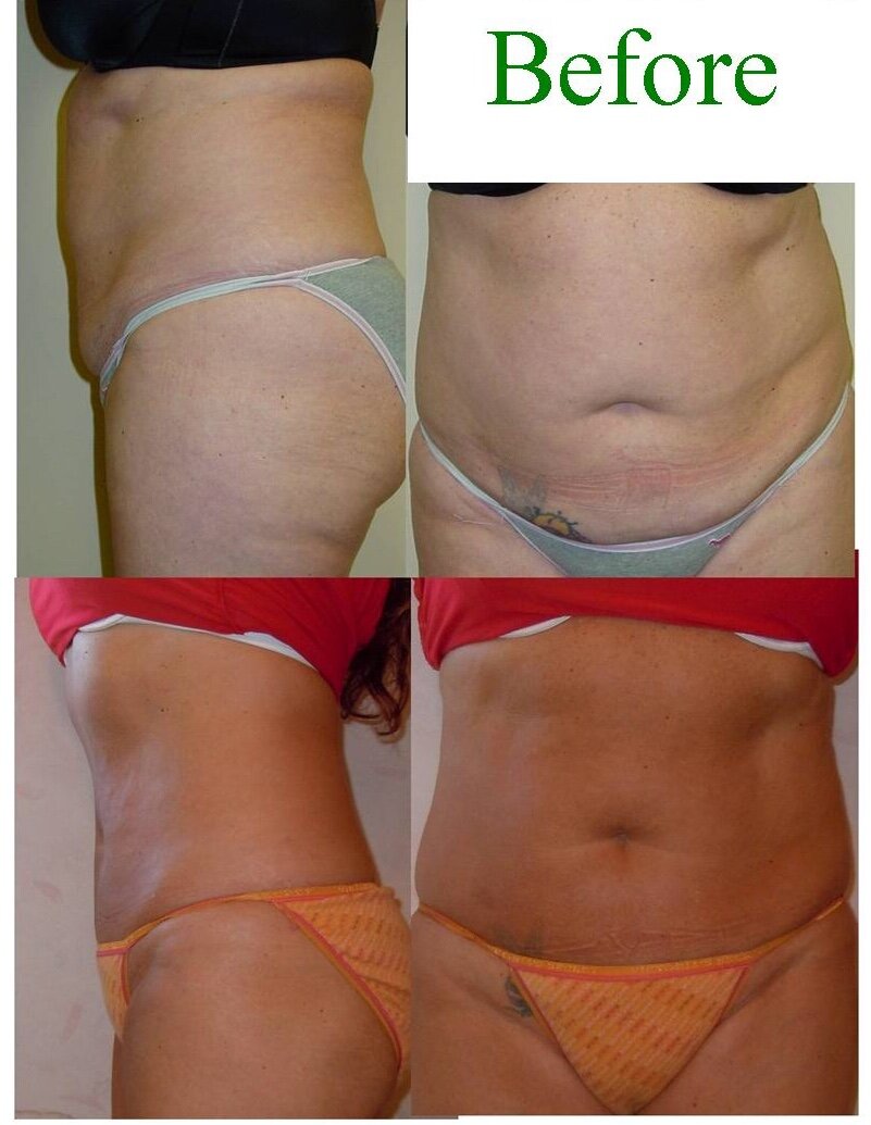 BodyFIRM