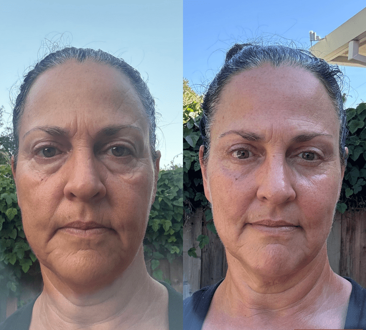 Fascia FaceLIFT Before and After 2