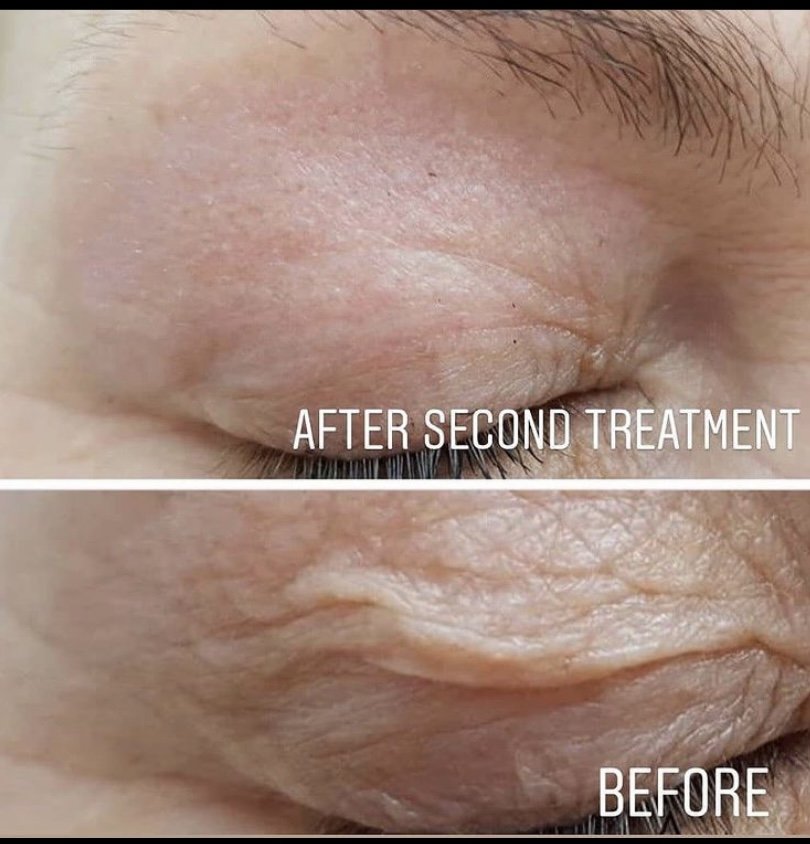PlasmaPEN Crepey Skin LiftingBefore & After: Real Client Results