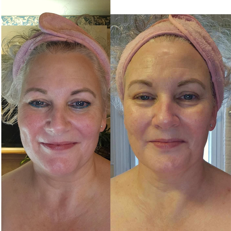 Fascia FaceLIFT Before and After 3