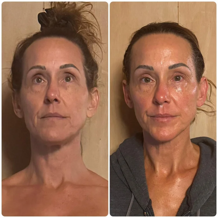 Fascia FaceLIFT Before and After 5