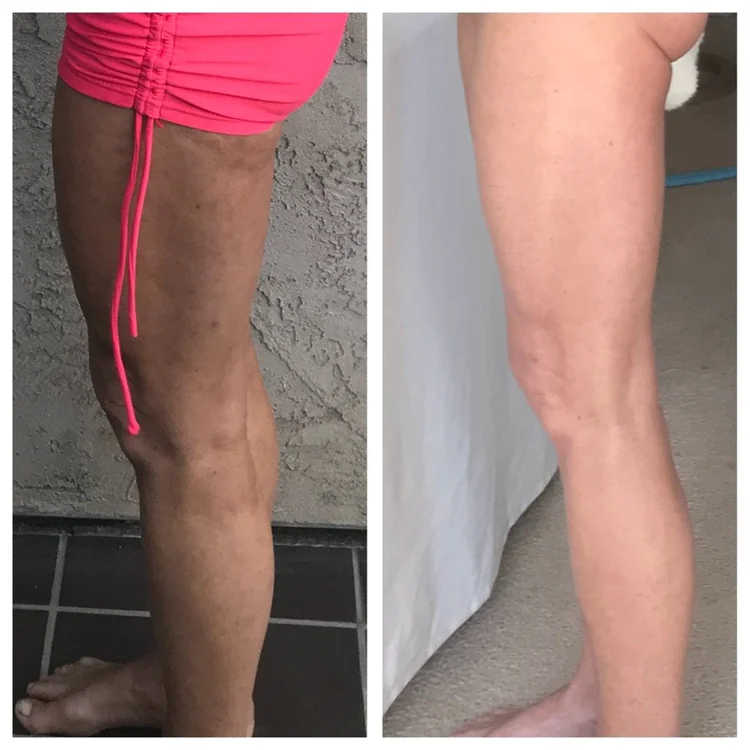 Cellulite Sculpt before and after showing smoother-looking legs over 6 months