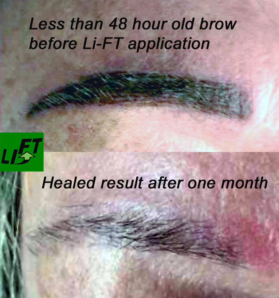 Lift Ink Removal  Shelly Kaplan Permanent Cosmetics
