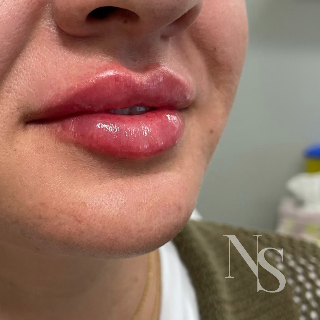 Lip filler