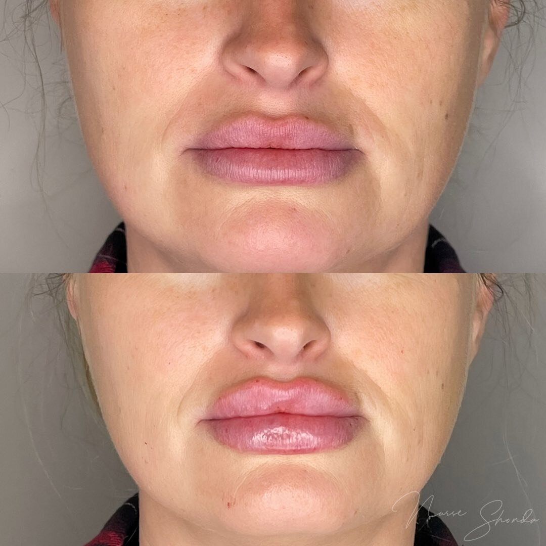 𝙋𝙡𝙪𝙢𝙥𝙚𝙙 𝙪𝙥 👄⁣⁣
⁣⁣
Are you looking for a voluptuous plump or more of a natural enhancement? We customize our treatments based on client goals, taking their natural anatomy into account.⁣⁣
⁣⁣
𝐓𝐫𝐞𝐚𝐭𝐦𝐞𝐧𝐭:⁣⁣⁣
Full syringe lip filler ⁣⁣
