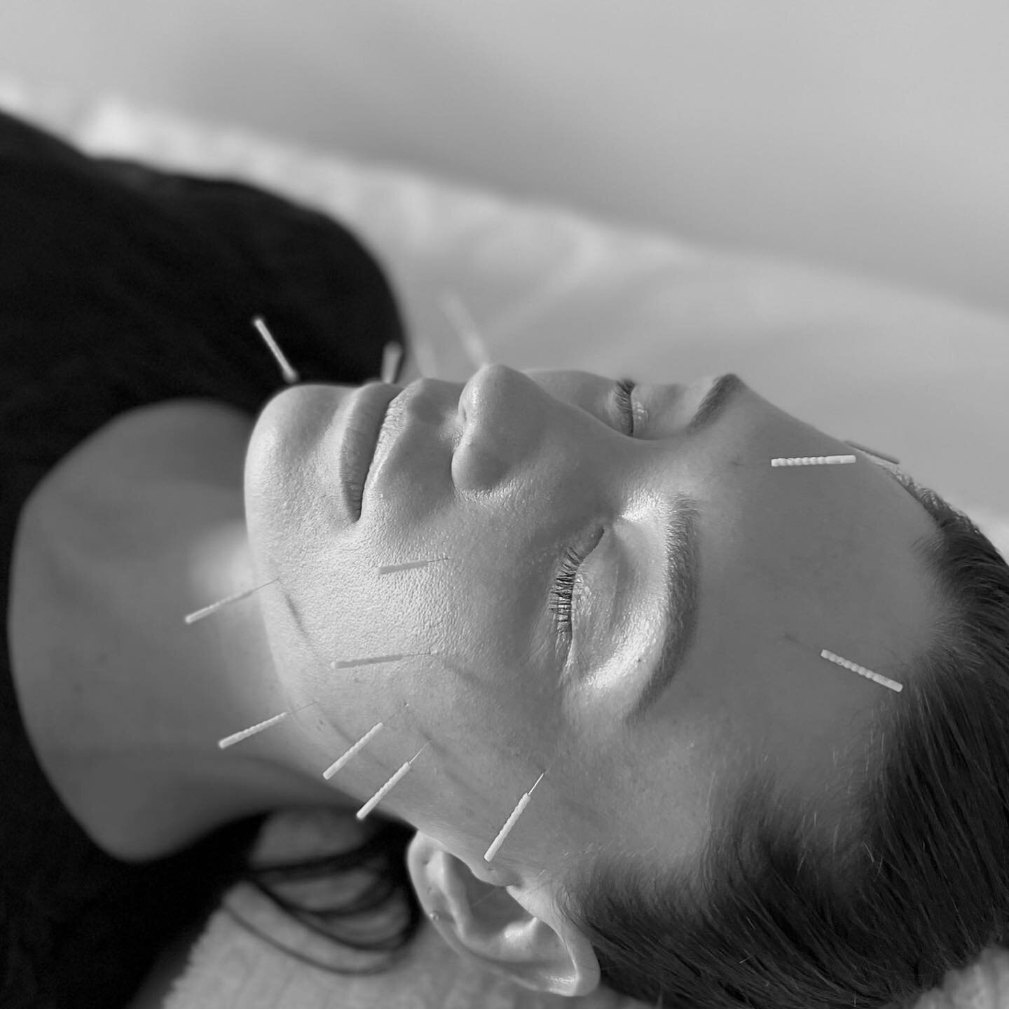 Cosmetic acupuncture results depend not only on your commitment to regular treatments &mdash; but your commitment to self care too. 
Ensuring a diet rich in varied vegetables and good fats, water intake &amp; enjoyable exercise.