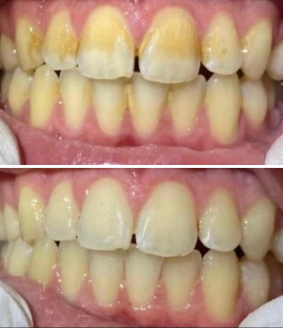 Comparison of teeth before and after cleaning or whitening, showing improved dental appearance.