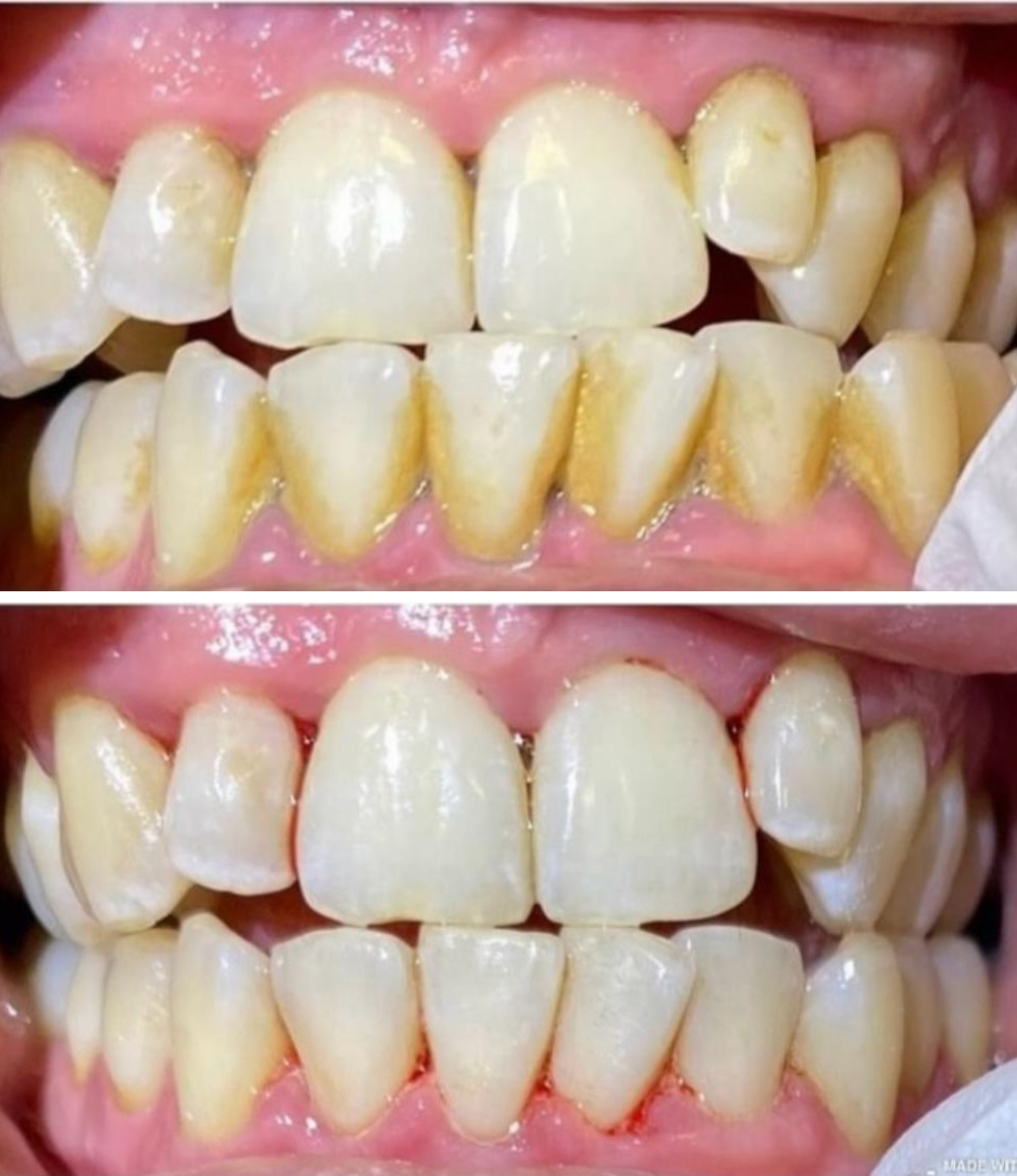 Comparison of teeth before and after ohh flow hygiene mage shows teeth with yellow plaque and stains, bottom image shows cleaner teeth with reduced stains.