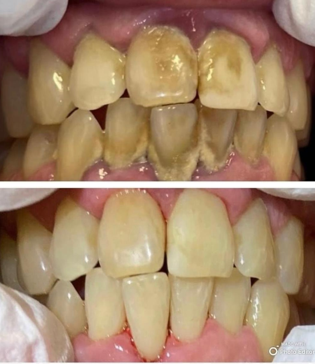 Comparison of teeth before and after cleaning. The top image shows teeth with heavy plaque and tartar buildup, while the bottom image shows teeth after cleaning, appearing much cleaner and healthier.