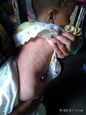 Skin conditions in the Sagaing Hills