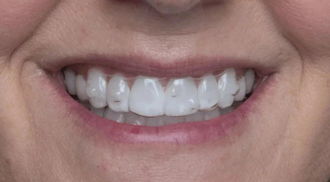 Close-up of a smile showing teeth wearing a clear aligner - How Long Does Invisalign Take in Westfield, IN?