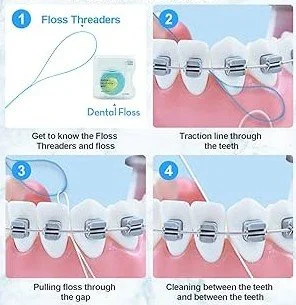Step-by-step guide on how to use a floss threader with braces - How to Floss with Braces in Westfield, IN