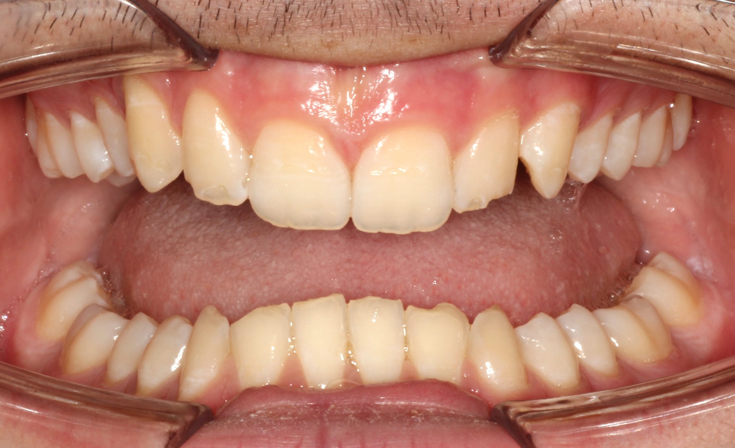 Close-up of teeth showing an overbite condition – braces for overbite in Westfield, IN.