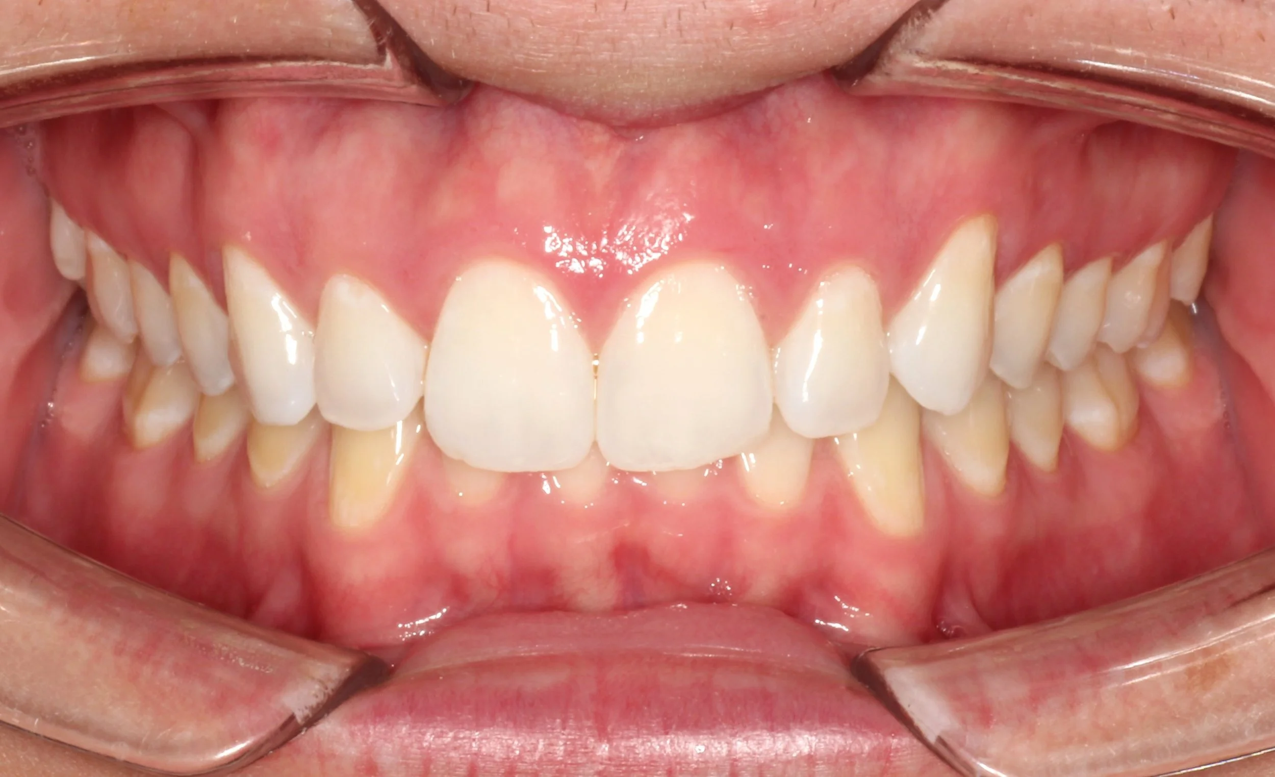 Anterior Occlusion 08312023.jpg