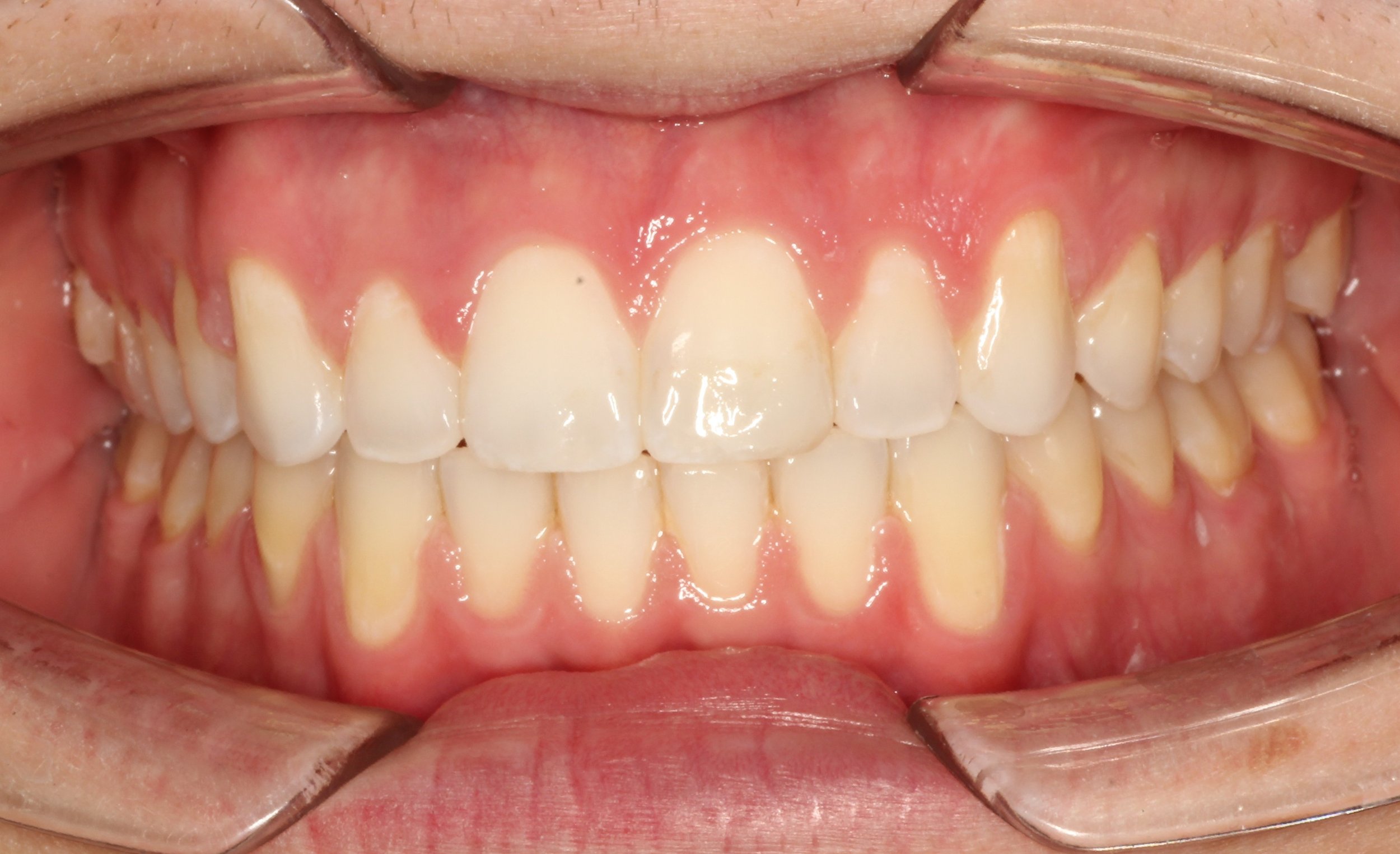 Anterior Occlusion 05202025.jpg