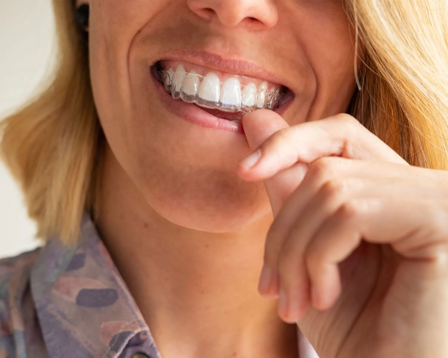 Person placing a clear aligner onto their teeth - How Does Invisalign Work in Westfield, IN?