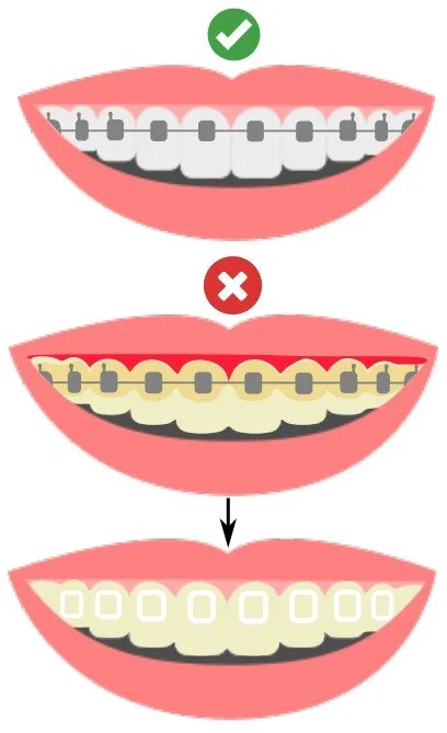 Illustration of proper oral hygiene steps for people with braces - How to Floss with Braces in Westfield, IN