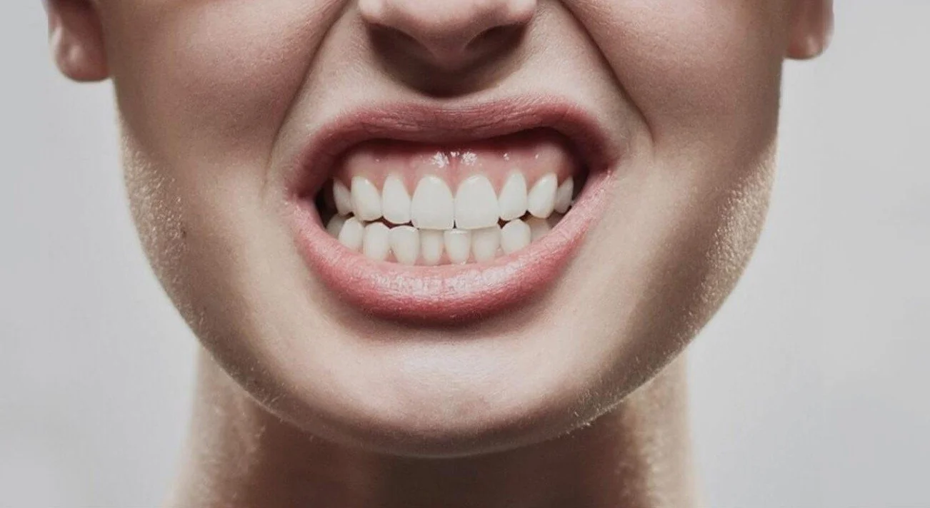 Close-up of a person clenching their teeth, showing jaw tension and tooth contact - TMJ Treatment in Westfield, IN