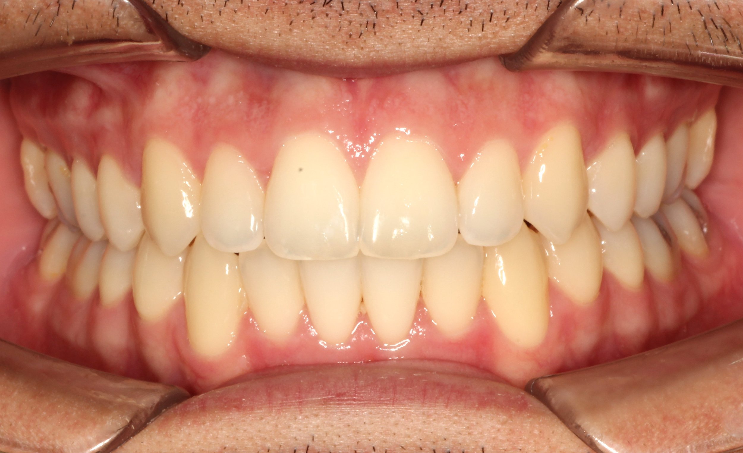 Image showing ideal bite alignment – braces for overbite in Westfield, IN.