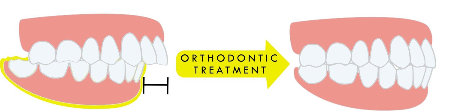 Illustration of overbite correction through orthodontic treatment – braces for overbite in Westfield, IN.