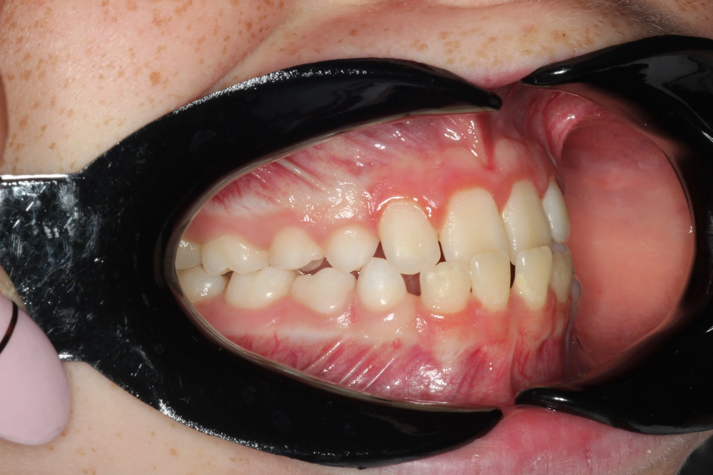 Close-up of teeth with dental retractor showing bite alignment - Overbite vs. Underbite in Westfield, IN