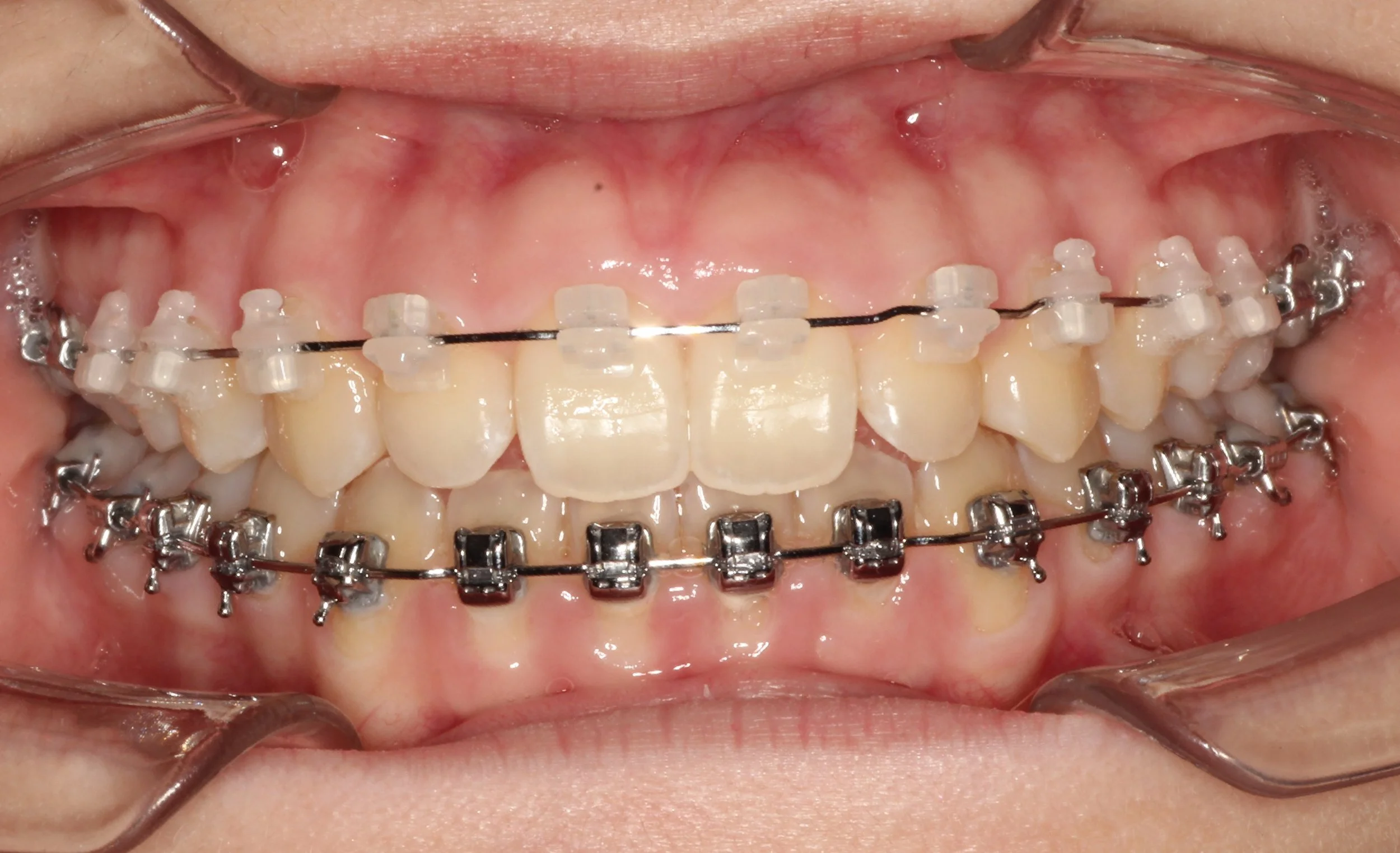 Teeth with clear braces correcting anterior occlusion – braces for overbite in Westfield, IN