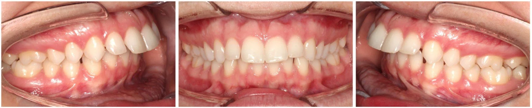 Diagram showing different perspective of overbite – braces for overbite in Westfield, IN.