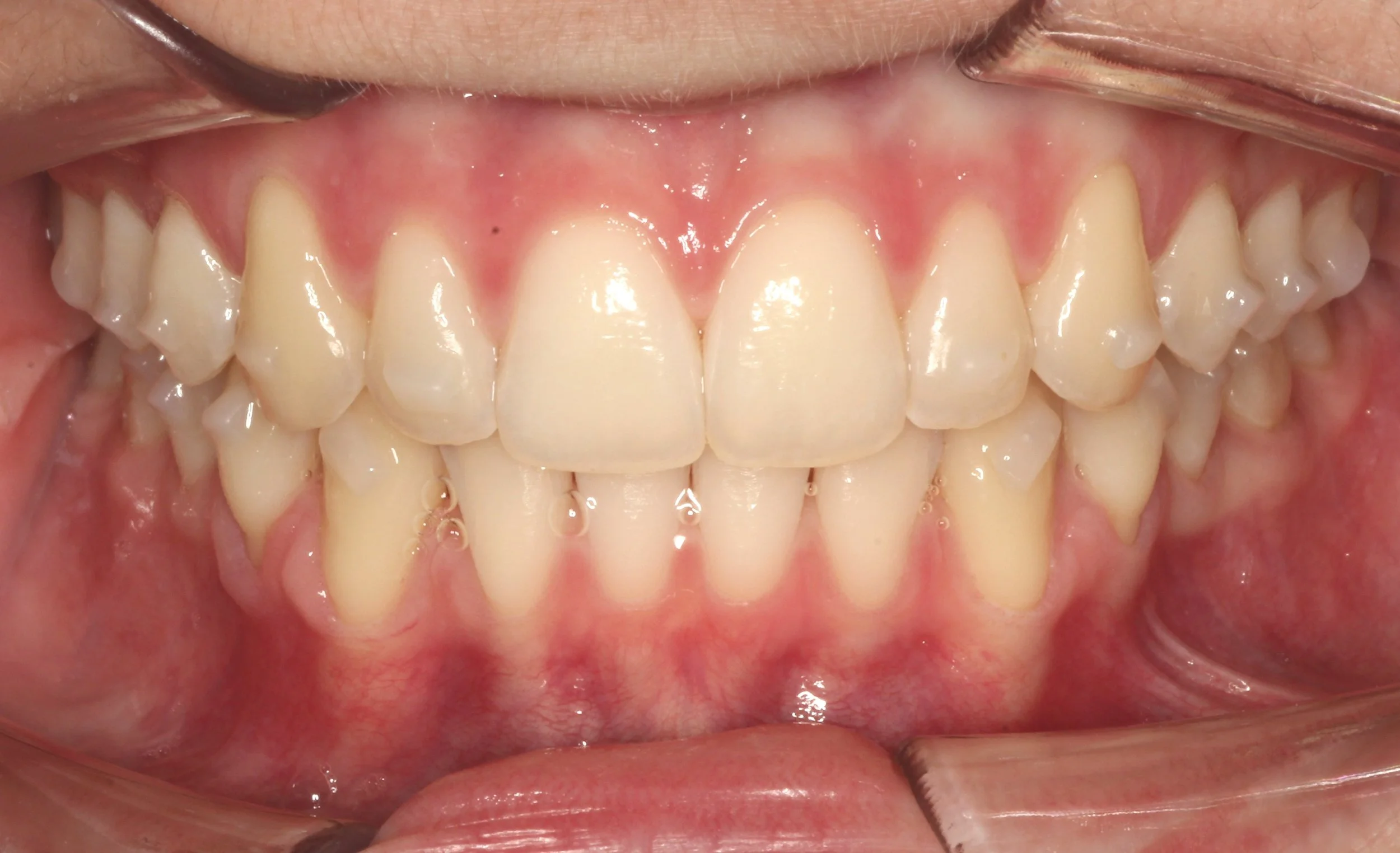 Close-up of straightened teeth with Invisalign clear aligners – braces for overbite in Westfield, IN.