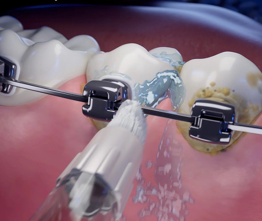 Water flosser cleaning between teeth and braces brackets - How to Floss with Braces in Westfield, IN