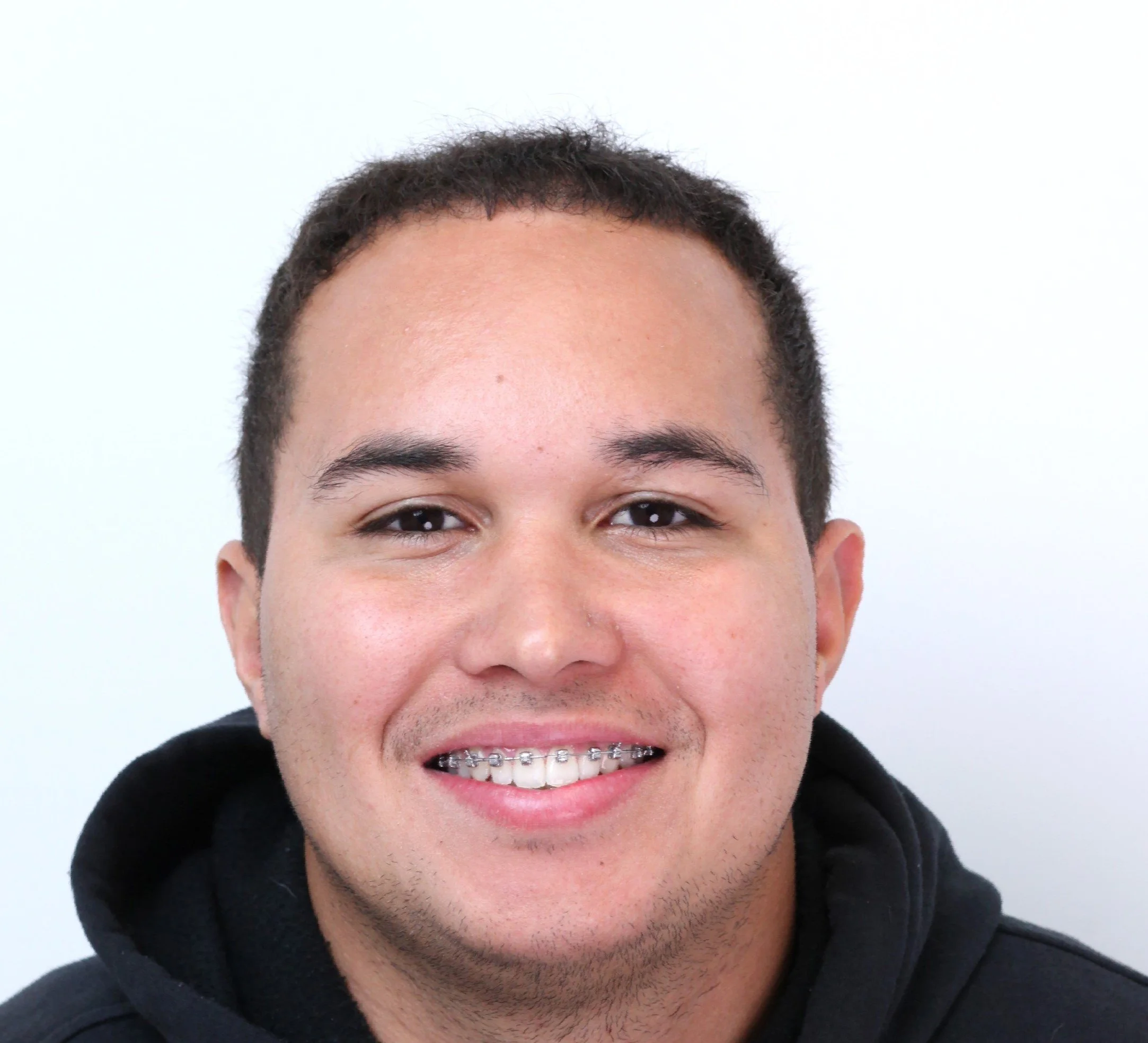 Young man smiling after orthodontic treatment – braces for overbite in Westfield, IN.
