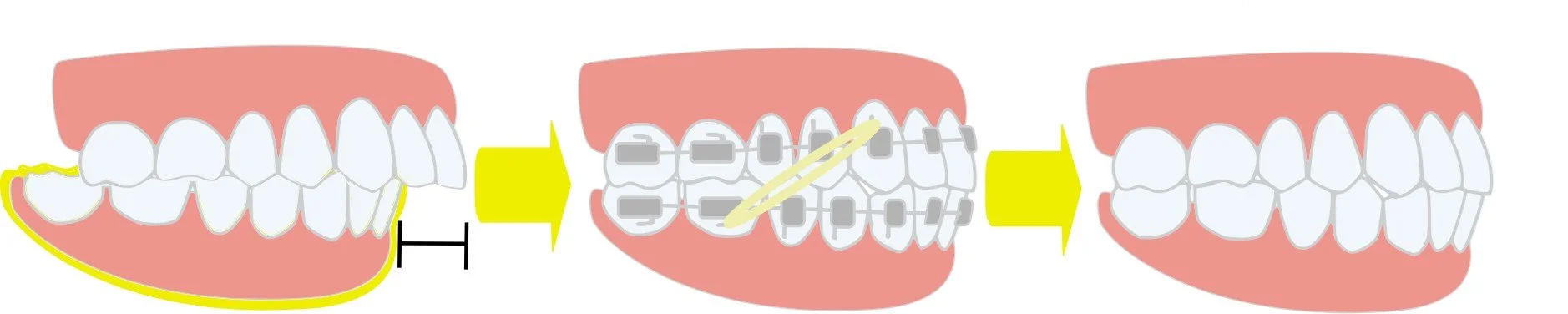 Diagram comparing properly aligned teeth with an uneven or misaligned bite  - TMJ Treatment in Westfield, IN