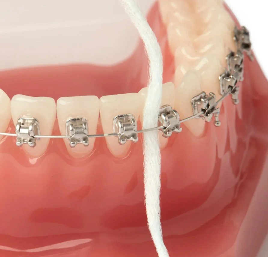 Superfloss being used to clean around braces on teeth - How to Floss with Braces in Westfield, IN