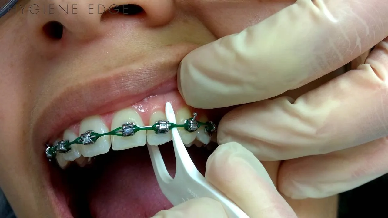 Person using a flosser to clean between braces brackets - How to Floss with Braces in Westfield, IN