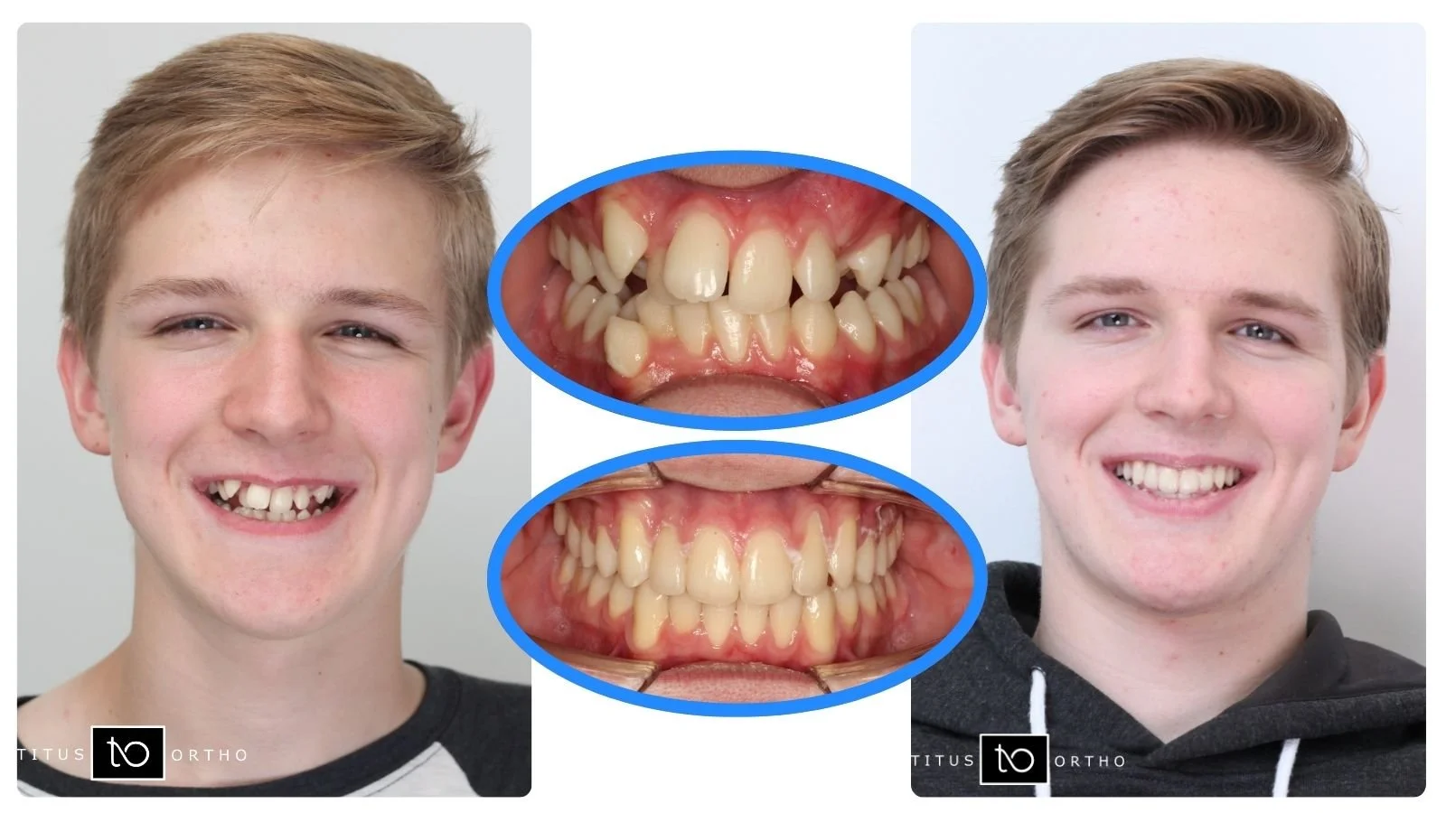 Before-and-after smile comparison showing correction of crowded teeth – braces for overbite in Westfield, IN.