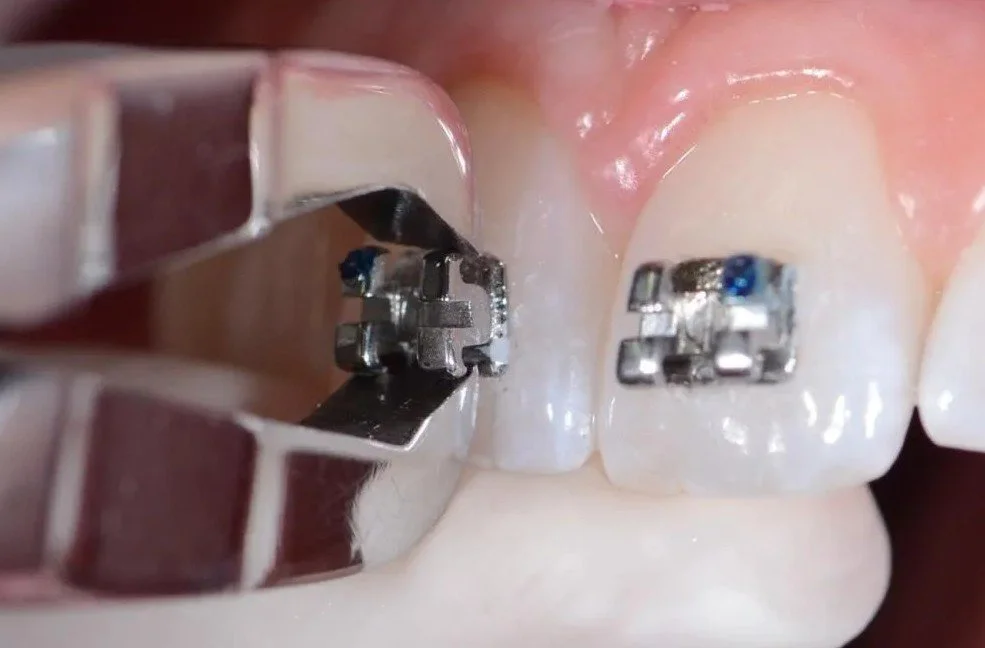 closeup dental tool removing an orthodontic bracket from a patients tooth - How to Get Braces Glue Off Teeth in Westfield, IN