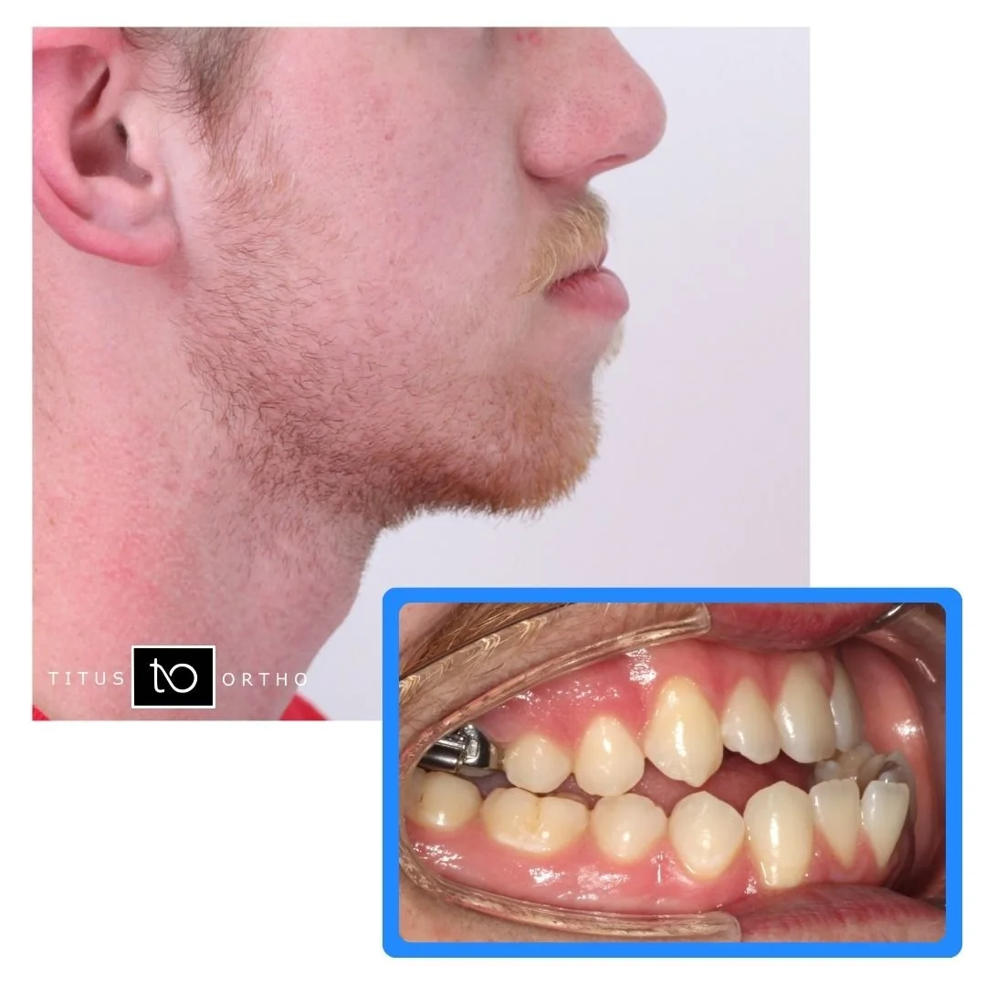 Profile view of a person with an underbite and inset image of teeth - Overbite vs. Underbite in Westfield, IN