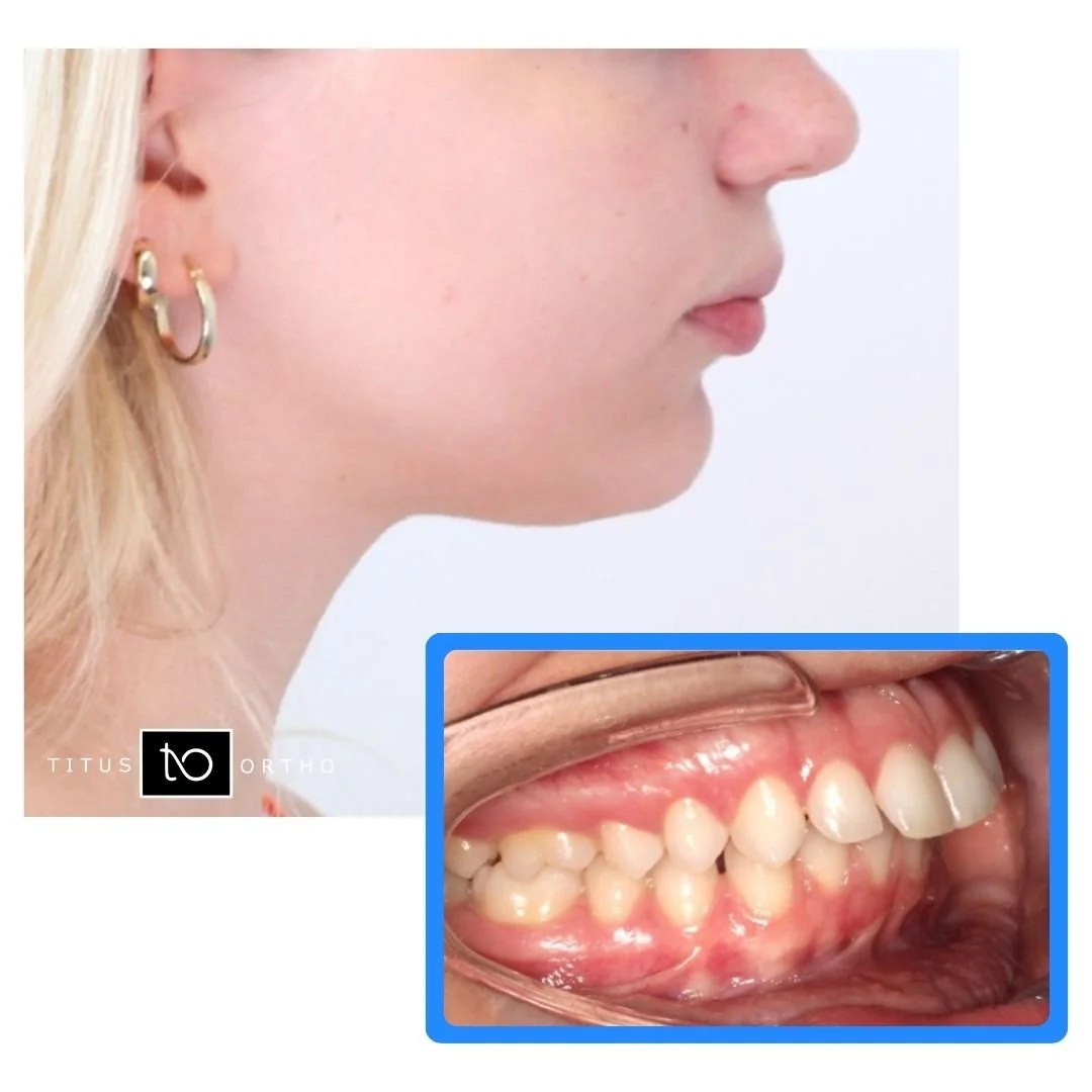 Profile view of a person with an overbite and inset image of teeth - Overbite vs. Underbite in Westfield, IN