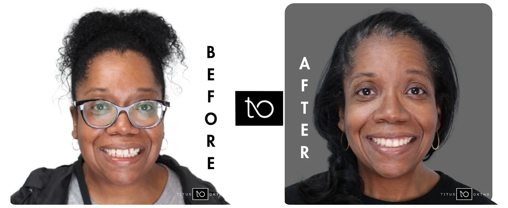 Before-and-after transformation showing orthodontic results – Does Insurance Cover Invisalign in Westfield, IN?