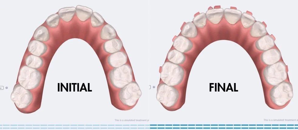 Before-and-after dental diagram showing teeth alignment improvement with clear aligners - How Long Does Invisalign Take in Westfield, IN?