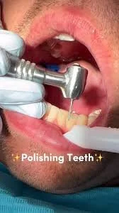 closeup of a dental tool polishing a tooth inside a patients mouth - How to Get Braces Glue Off Teeth in Westfield, IN
