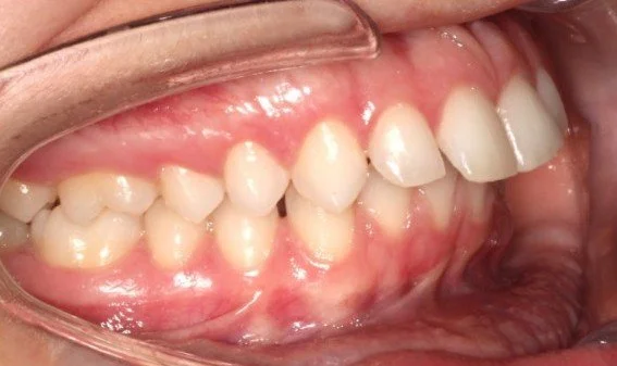 Side view of teeth showing overbite and dental alignment – Can Invisalign Fix Overbite in Westfield, IN.