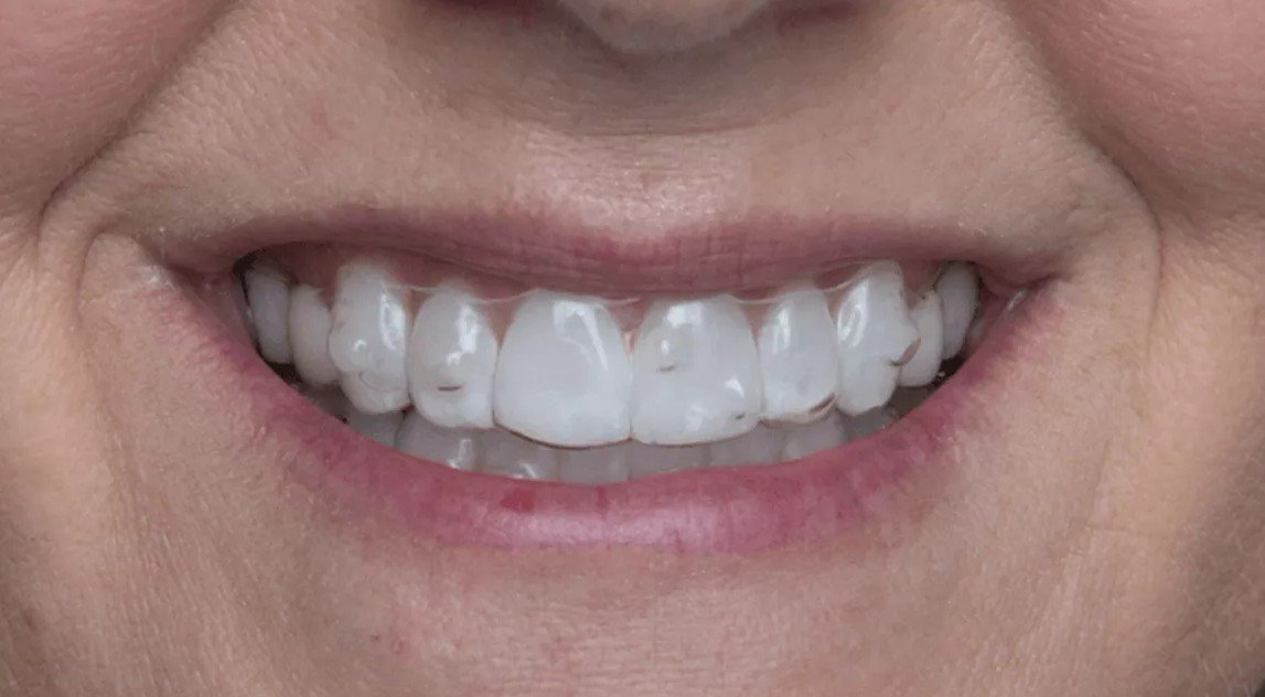 Close-up smile showing clear aligners on teeth – Can Invisalign Fix Overbite in Westfield, IN.