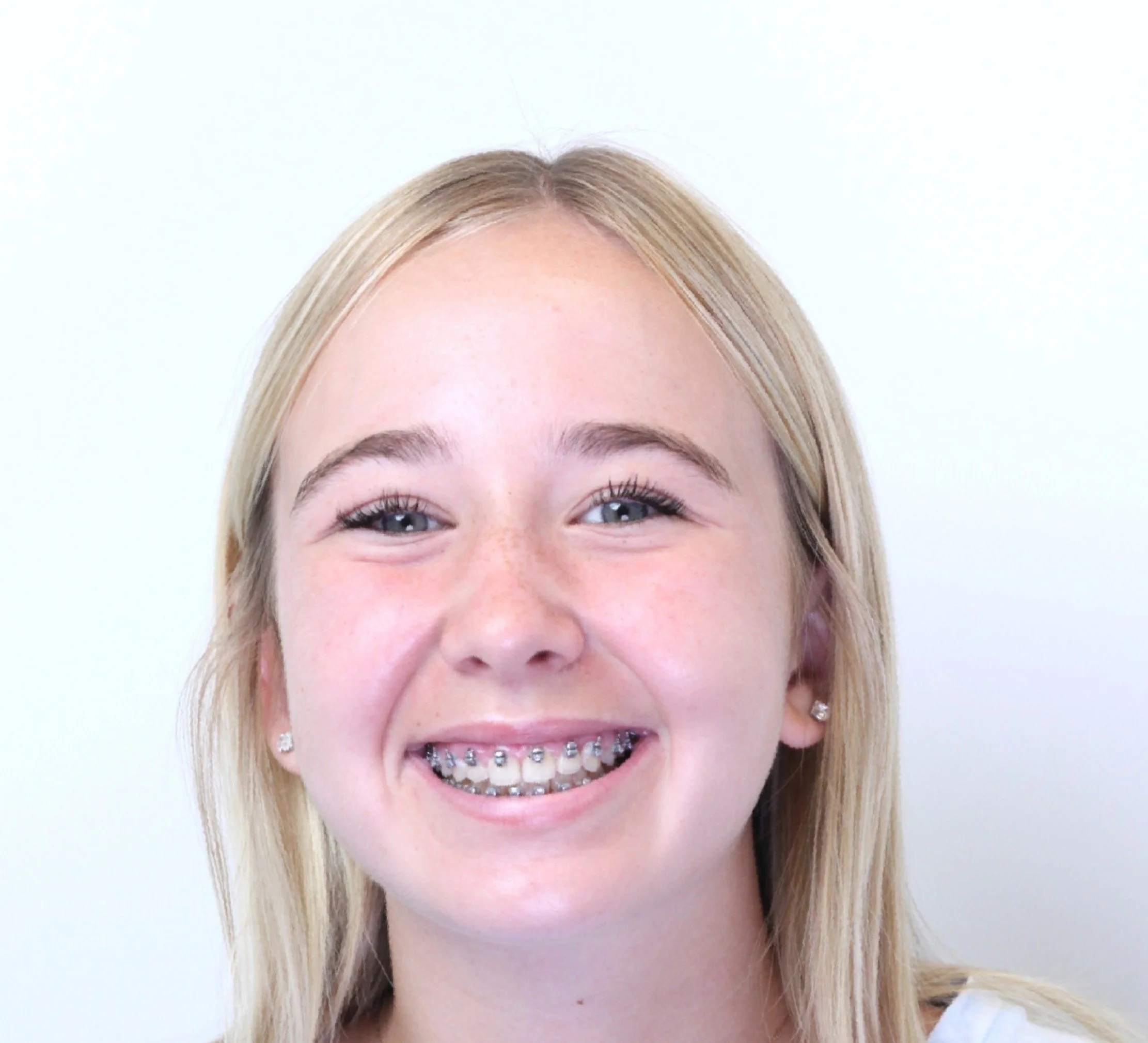 Teen smiling with metal braces on teeth – braces for overbite in Westfield, IN.
