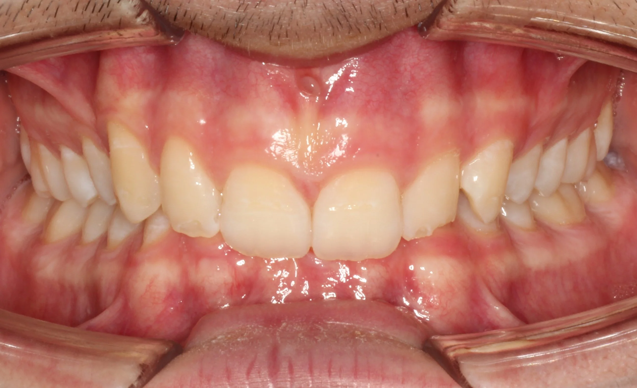 Close-up of teeth showing an overbite condition – braces for overbite in Westfield, IN.