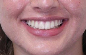 Close-up of a smiling mouth showing straight, evenly aligned teeth after orthodontic treatment - How Does Invisalign Work in Westfield, IN?