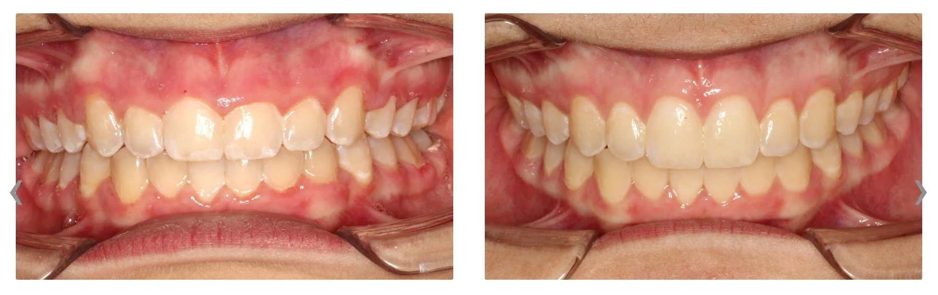 before and after close up photo of gums showing gingivectomy results - How to Get Braces Glue Off Teeth in Westfield, IN