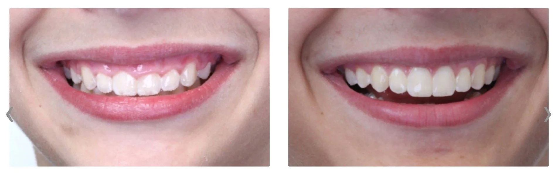 two closeup photo of a persons smile showing gum reshaping results - How to Get Braces Glue Off Teeth in Westfield, IN