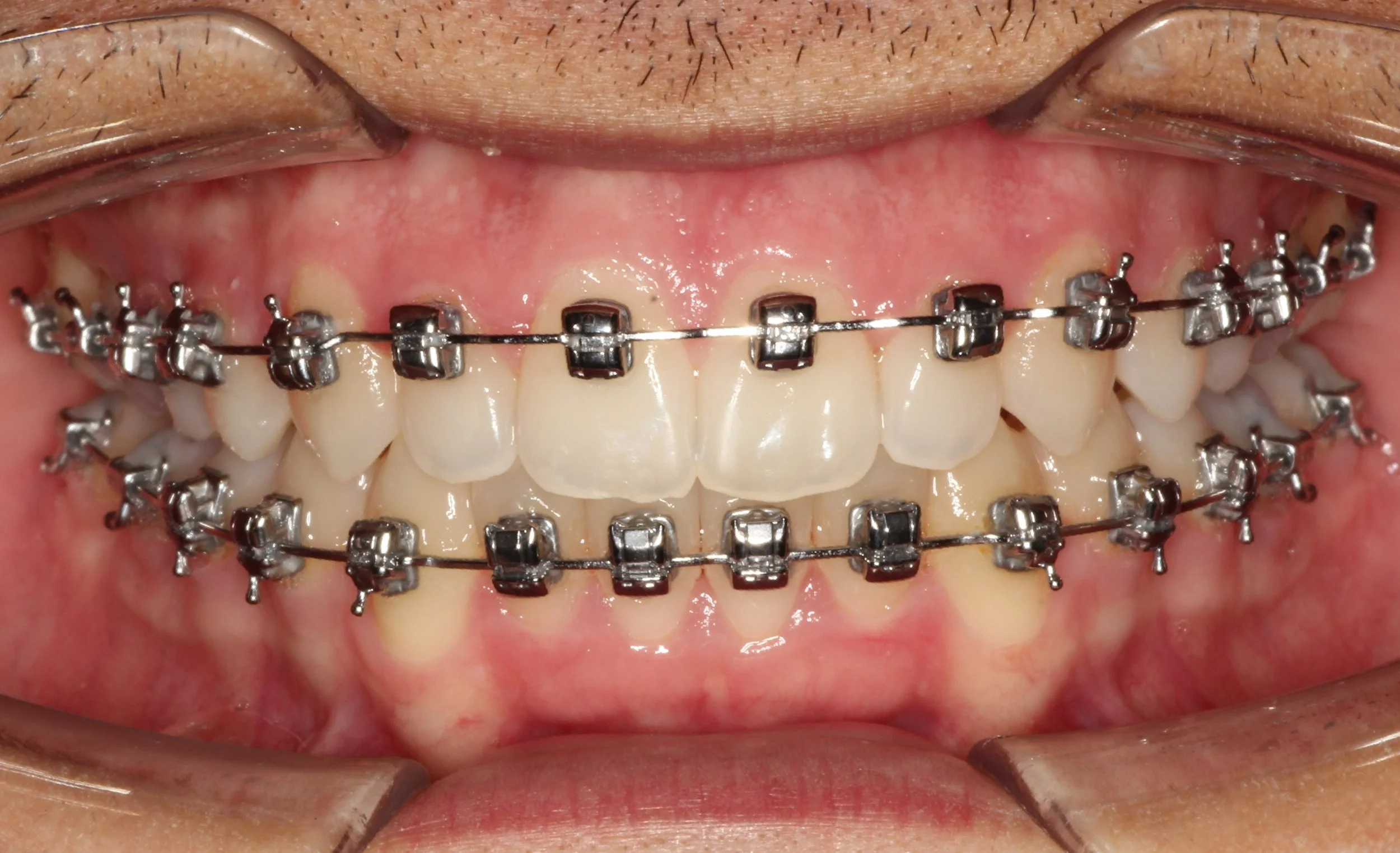 Teeth with metal braces correcting anterior occlusion – braces for overbite in Westfield, IN.