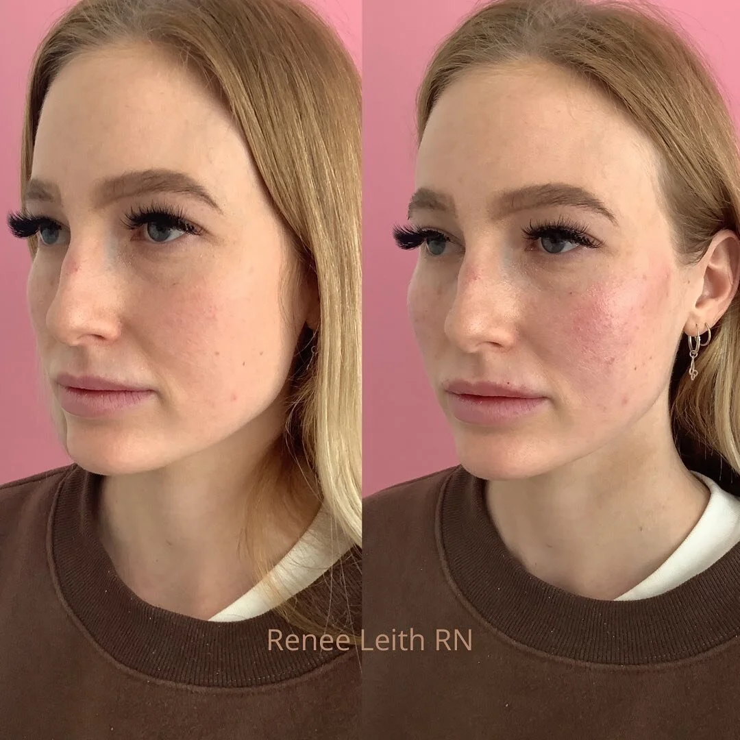 A little tweak to the cheeks 😍