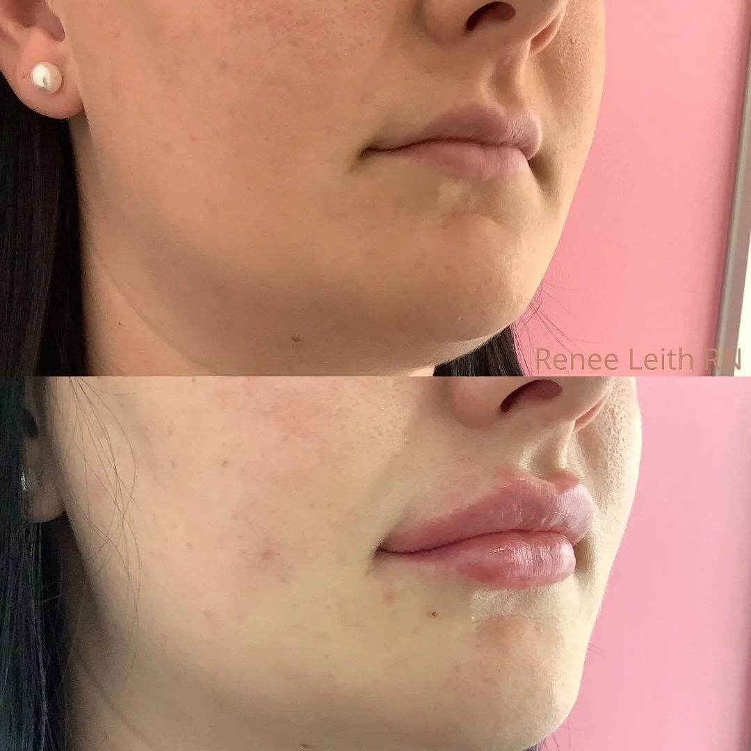 Before and after 2 syringes over 2months 😍💋

When I build the lip, I like to place 1ml at a time, waiting around 2mths before we inject the 2nd ml. Slow and steady 💉